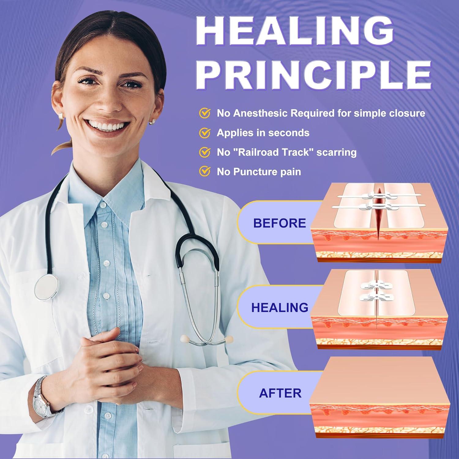 Kit de Cierre de Heridas Mariposa SYNTHGENE 4 Pcs 6-7 cm