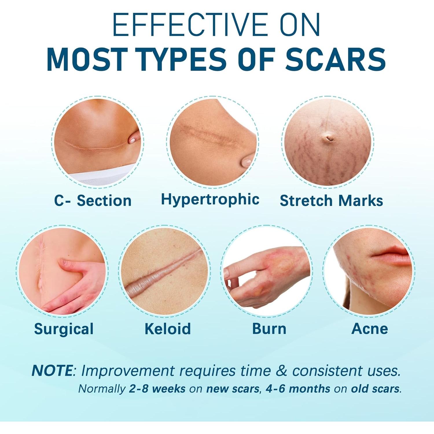 Hojas de Silicona para Cicatrices LotFancy 10pcs 3.81x15.24cm