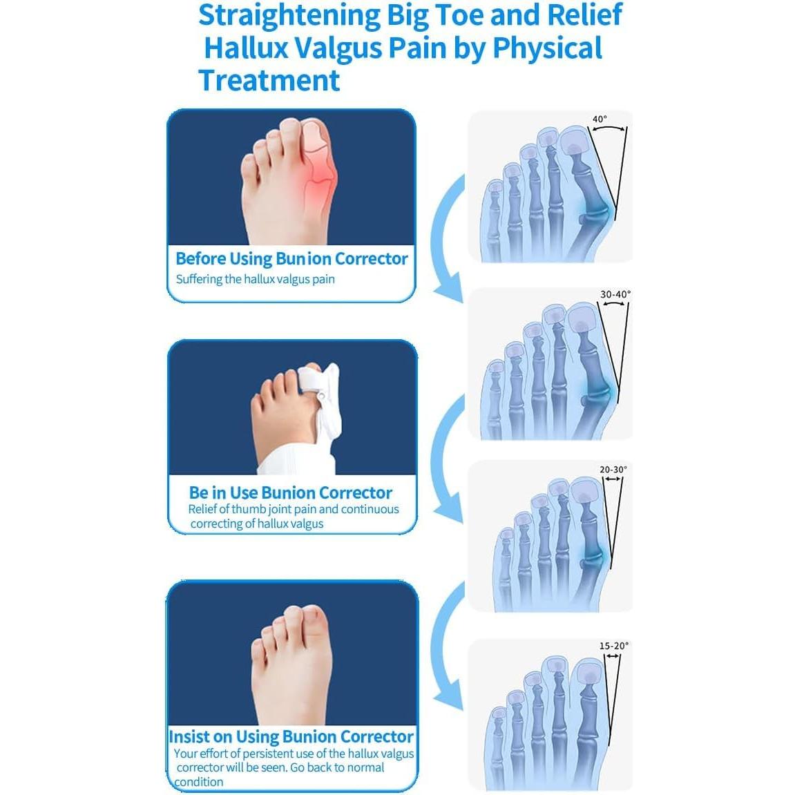 Corrector de Juanetes Ajustable XREKNOi Modelo 02 para Alivio