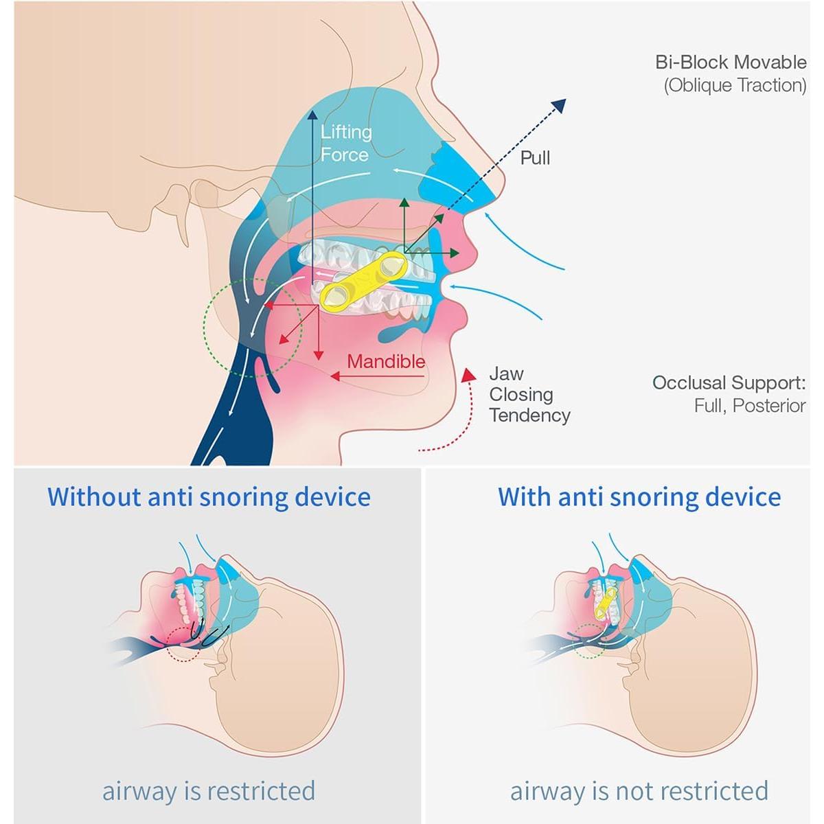 20 Correas Elásticas Reemplazo Makosmi Antisnoring 13mm Azul