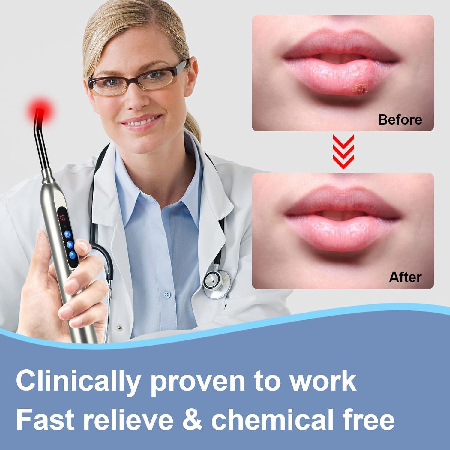 Dispositivo Terapia Luz Roja Topvent para Herpes Labial