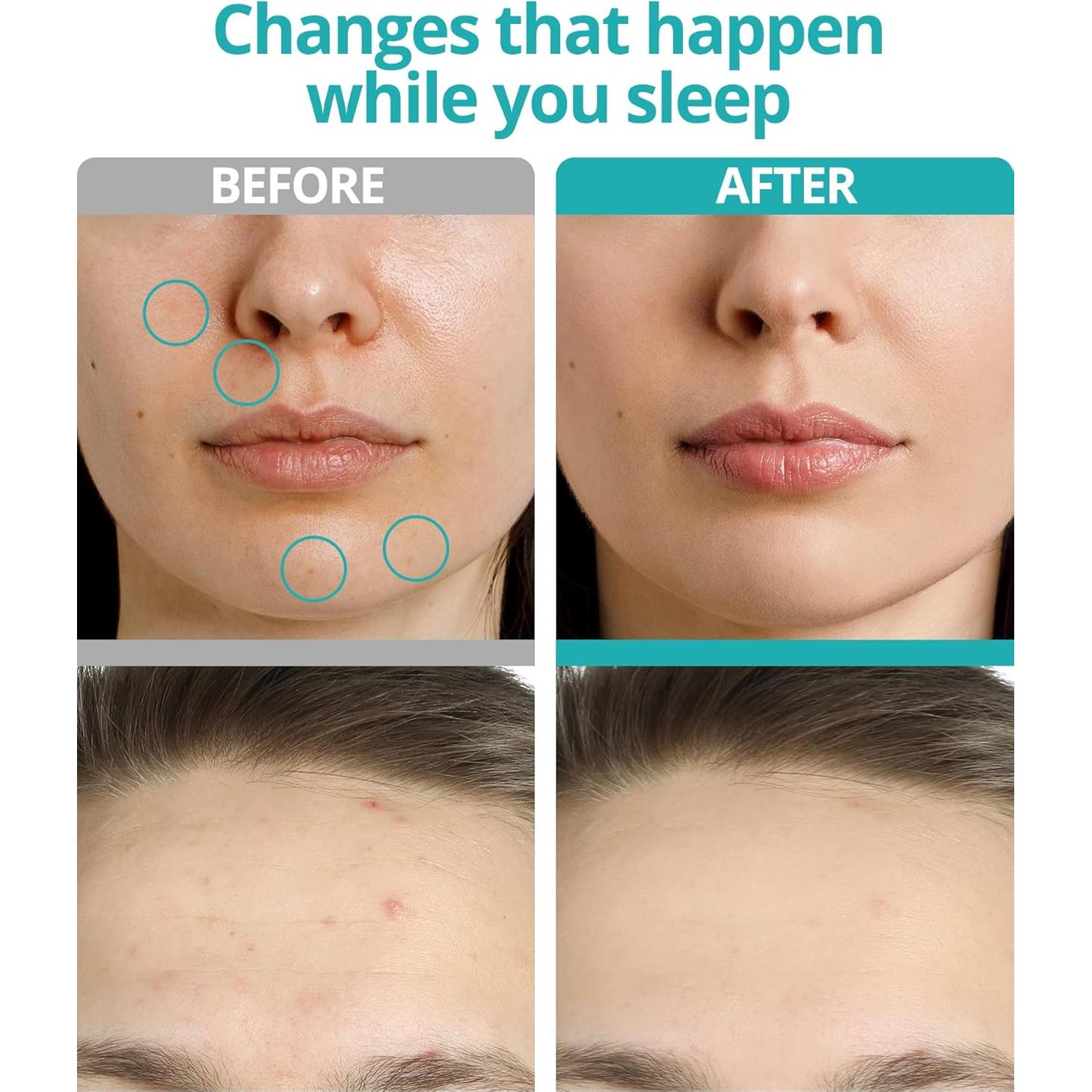 Parche Microdart para Acné VILVIN - 27 Unidades - Acción Rápida