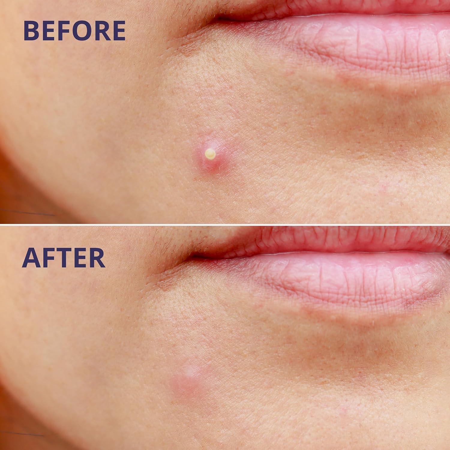 Parche Hidrocoloide para Granos Simple HG - 96 Unidades 12mm