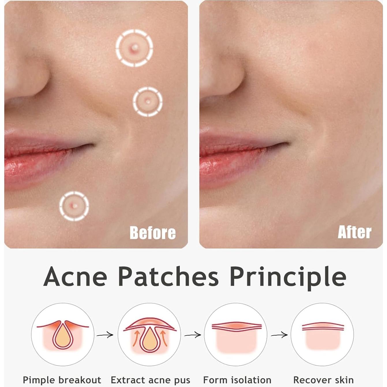 Parche Hidrocoloide Dazzlook para Granitos - 96 Pcs, 2 Tamaños