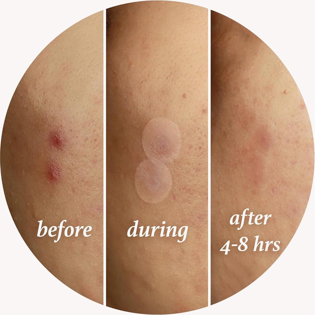 Parche Hidrocoloide Julep Me Up para Acné - 72 Piezas