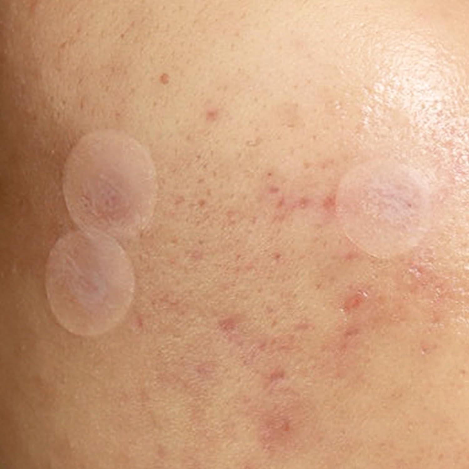 Parche Hidrocoloide Julep Me Up para Acné - 72 Piezas