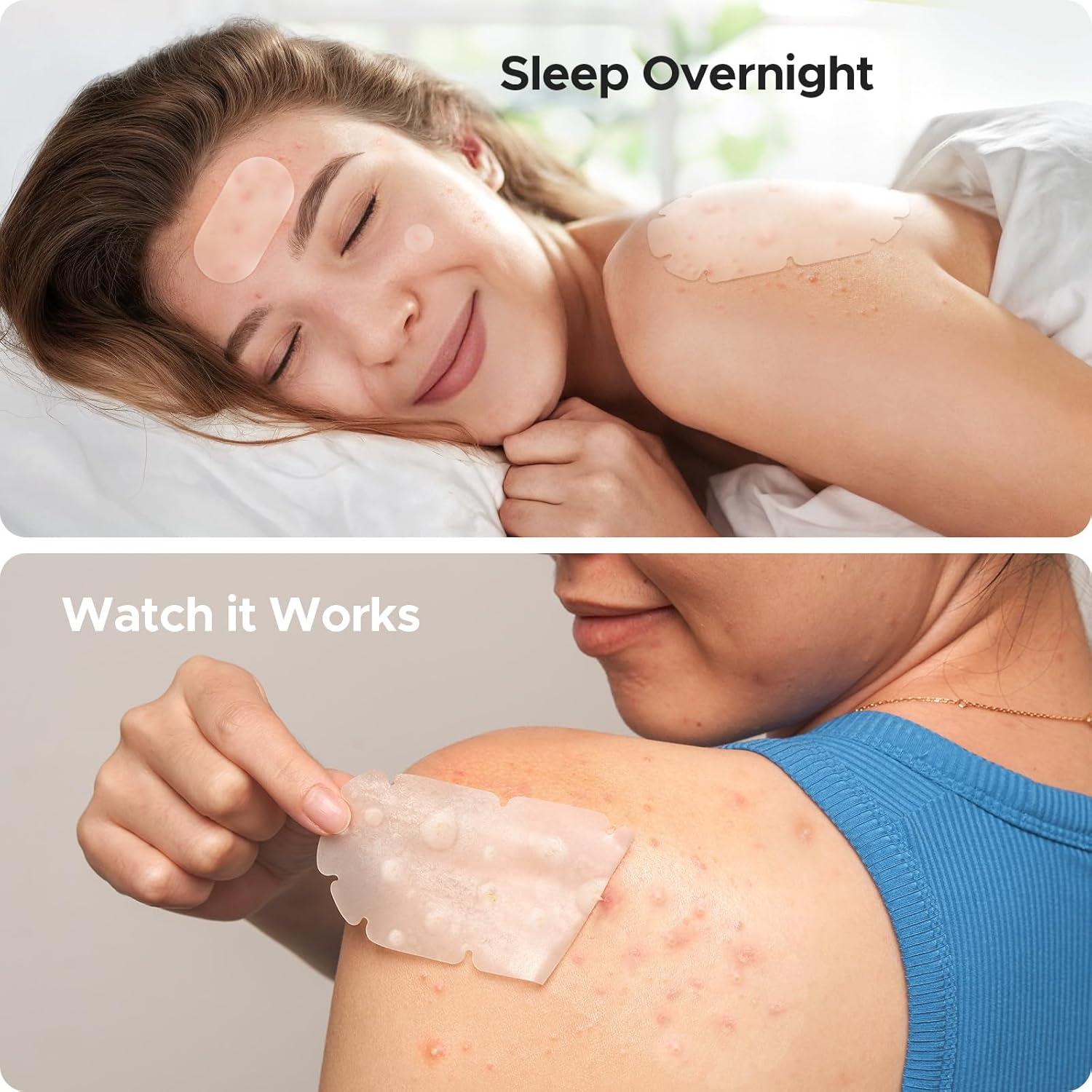 Parches para Acné Corporal TKTK XXL - 110 Unidades, 5 Tamaños