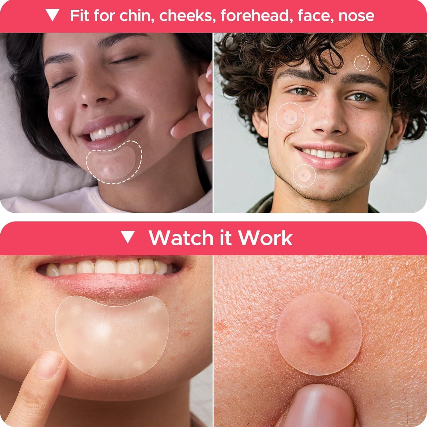 Parches para Granos LitBear - 224 Piezas, 5 Tamaños, Hidrocoloide