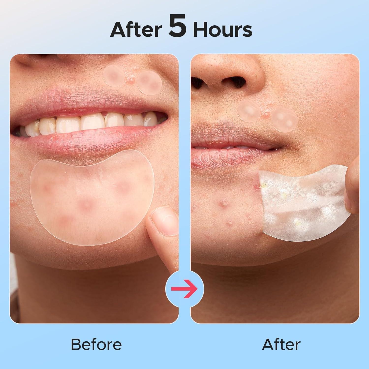 Parches para Granos LitBear - 224 Piezas, 5 Tamaños, Hidrocoloide