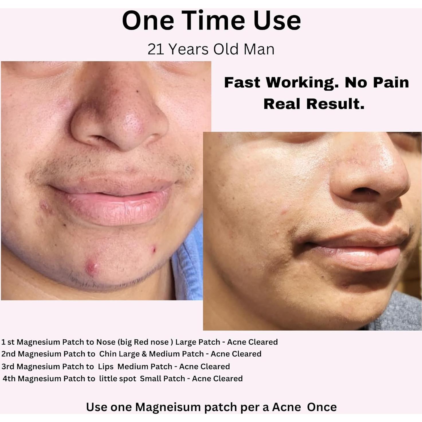 Parche de Magnesio Laflare para Acné y Manchas Oscuras - 10 Piezas