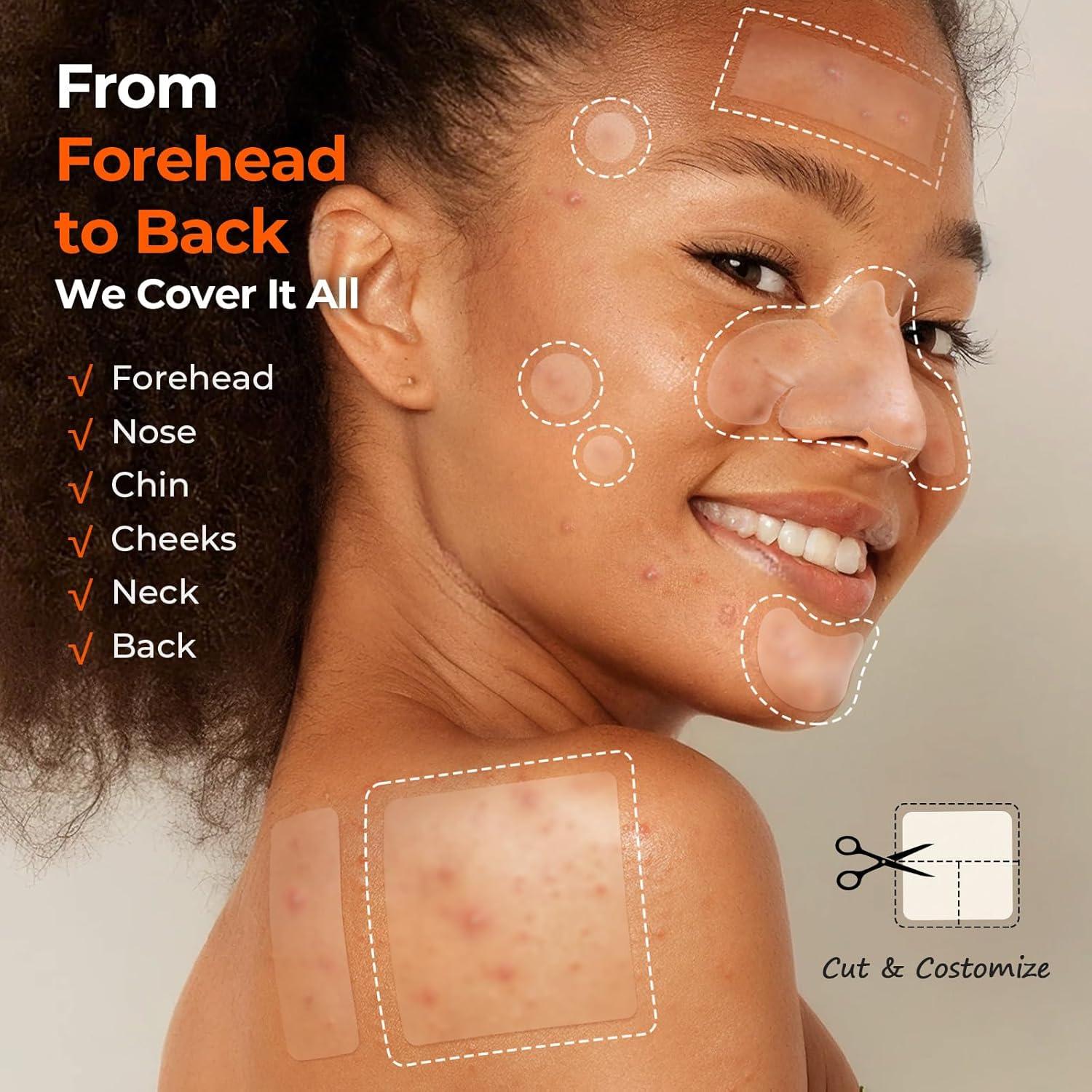 Parches para Acné TKTK Hidrocoloide 356 Unidades 6 Tamaños