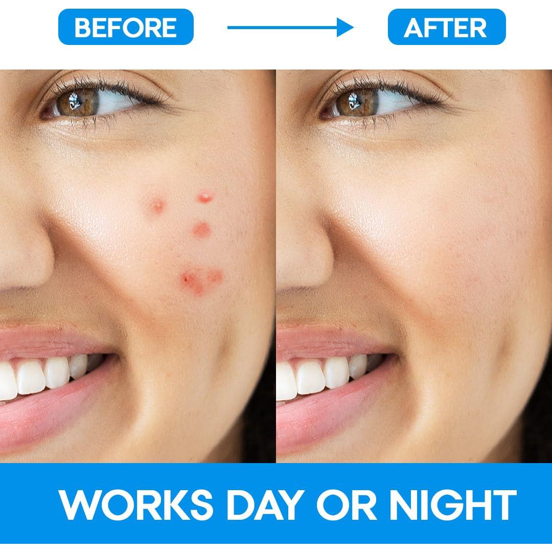 Parche para Acné EZACNE™ Hidrocoloide 36 Unidades