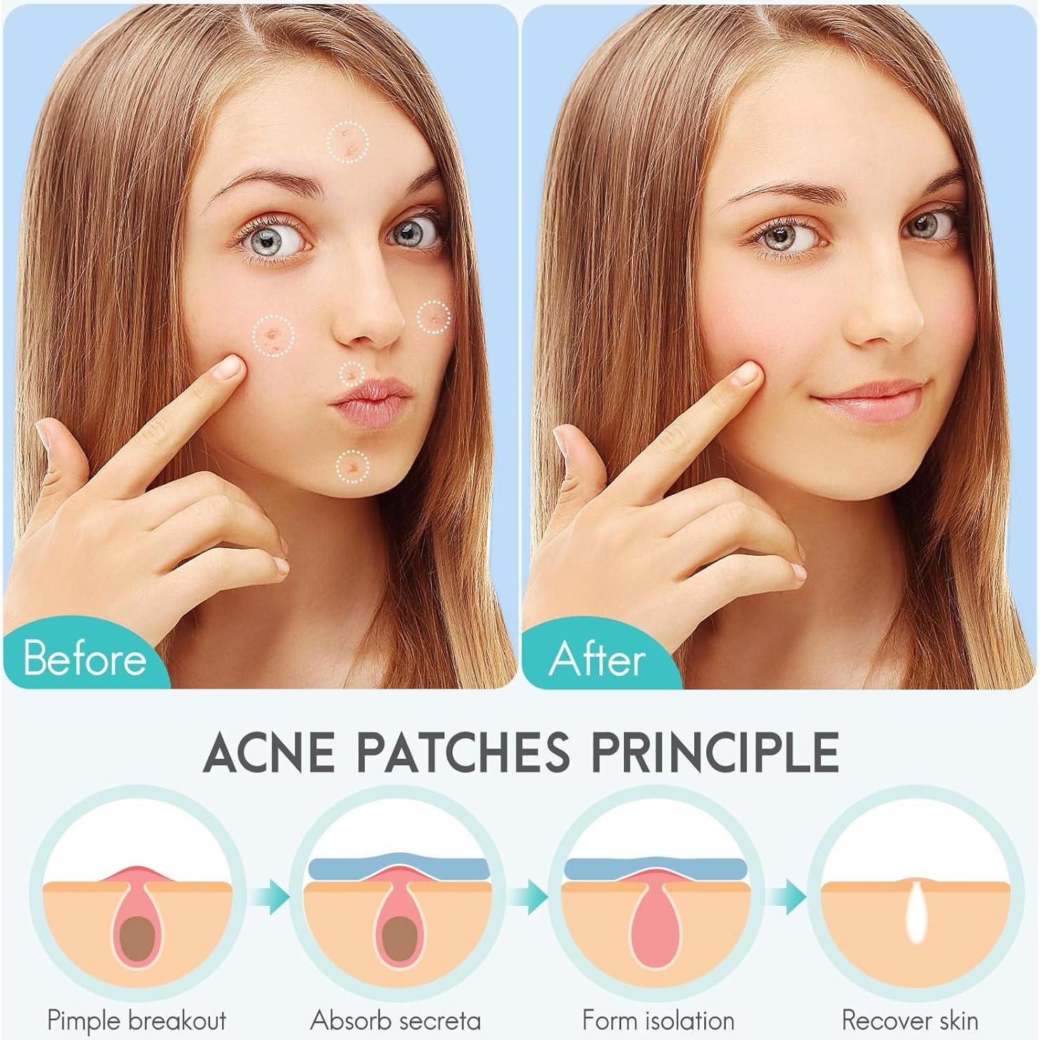 Parche hidrocoloide AOAWI para acné y granos, 350 piezas