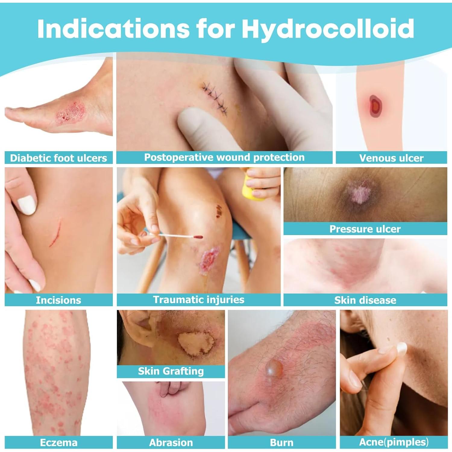 Rollos de Hidrocoloide LIFARA 5.08cm x 4.88m - Parche Cortable