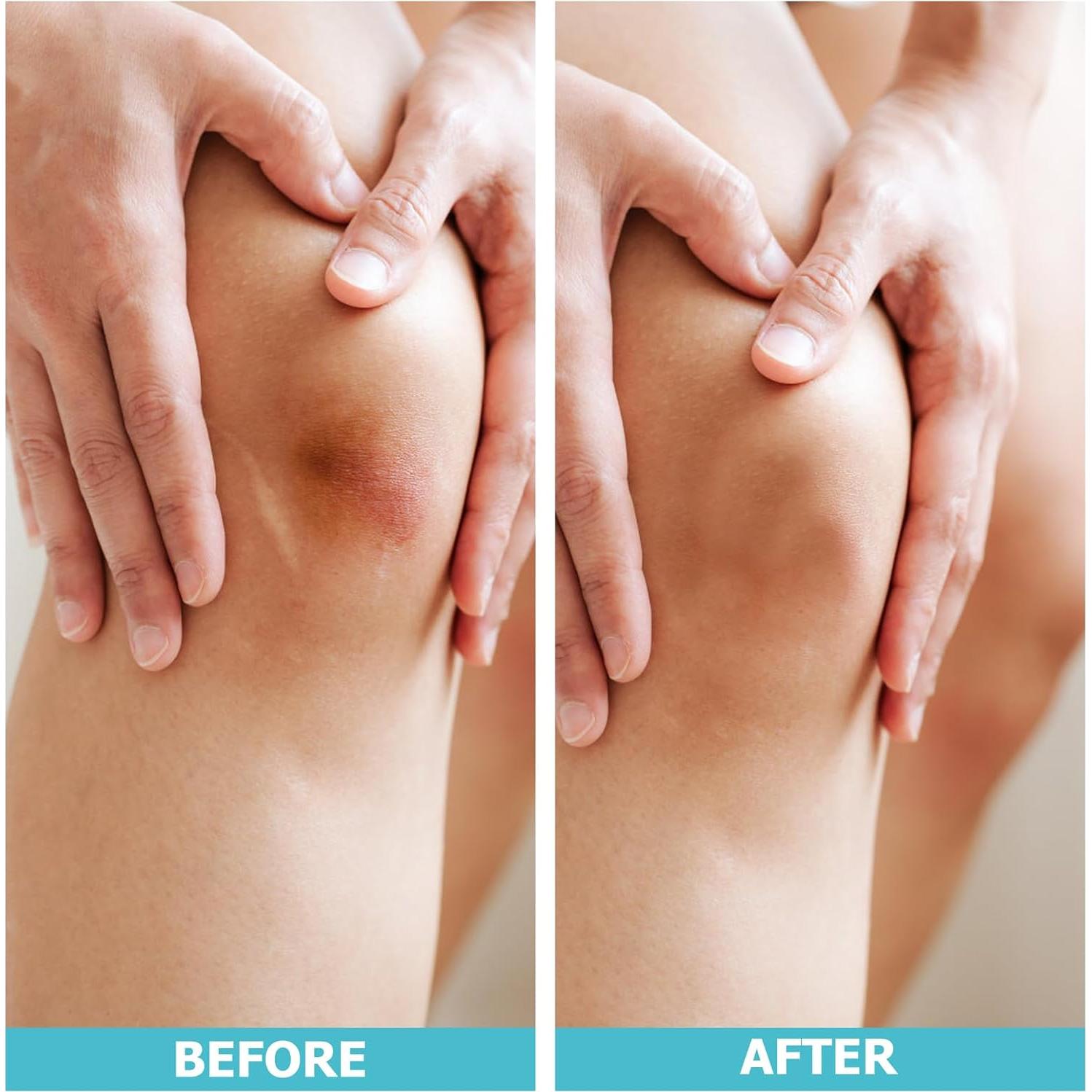 Rollos de Hidrocoloide LIFARA 5.08cm x 4.88m - Parche Cortable