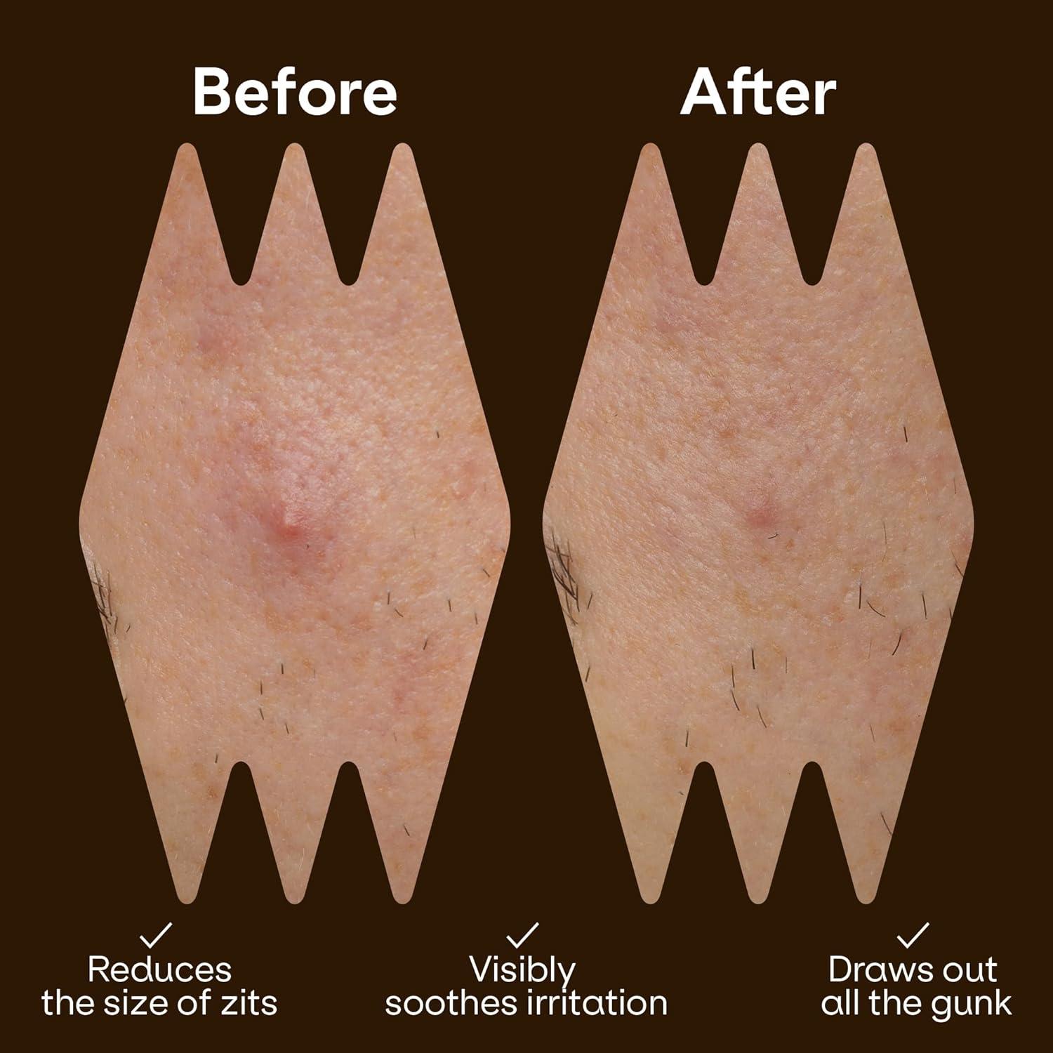 Parche Hidrocoloide para Acné ZVYK - 66 Parches Veganos