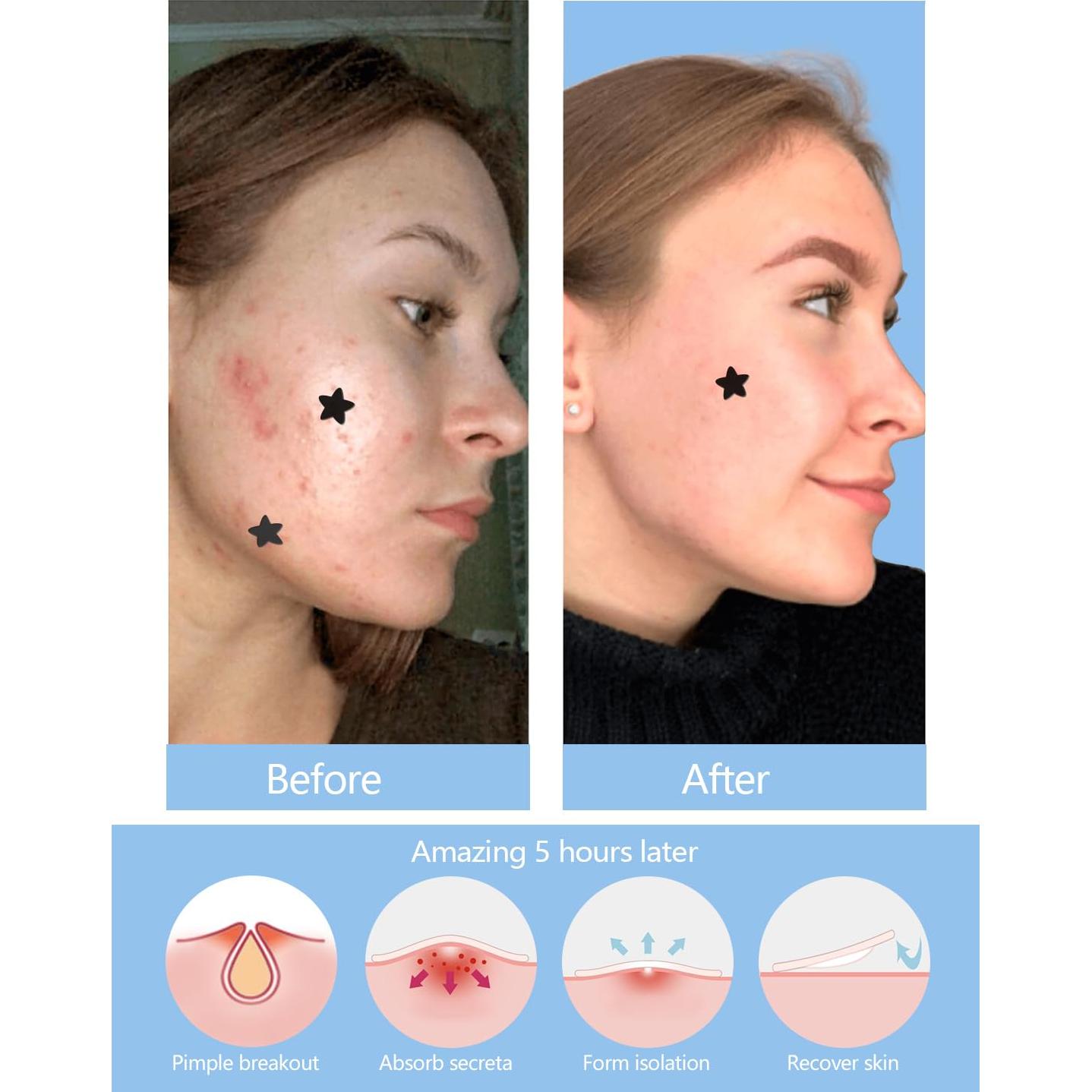 Parches para Granos Hidrocoloides Black Star - 153 Unidades