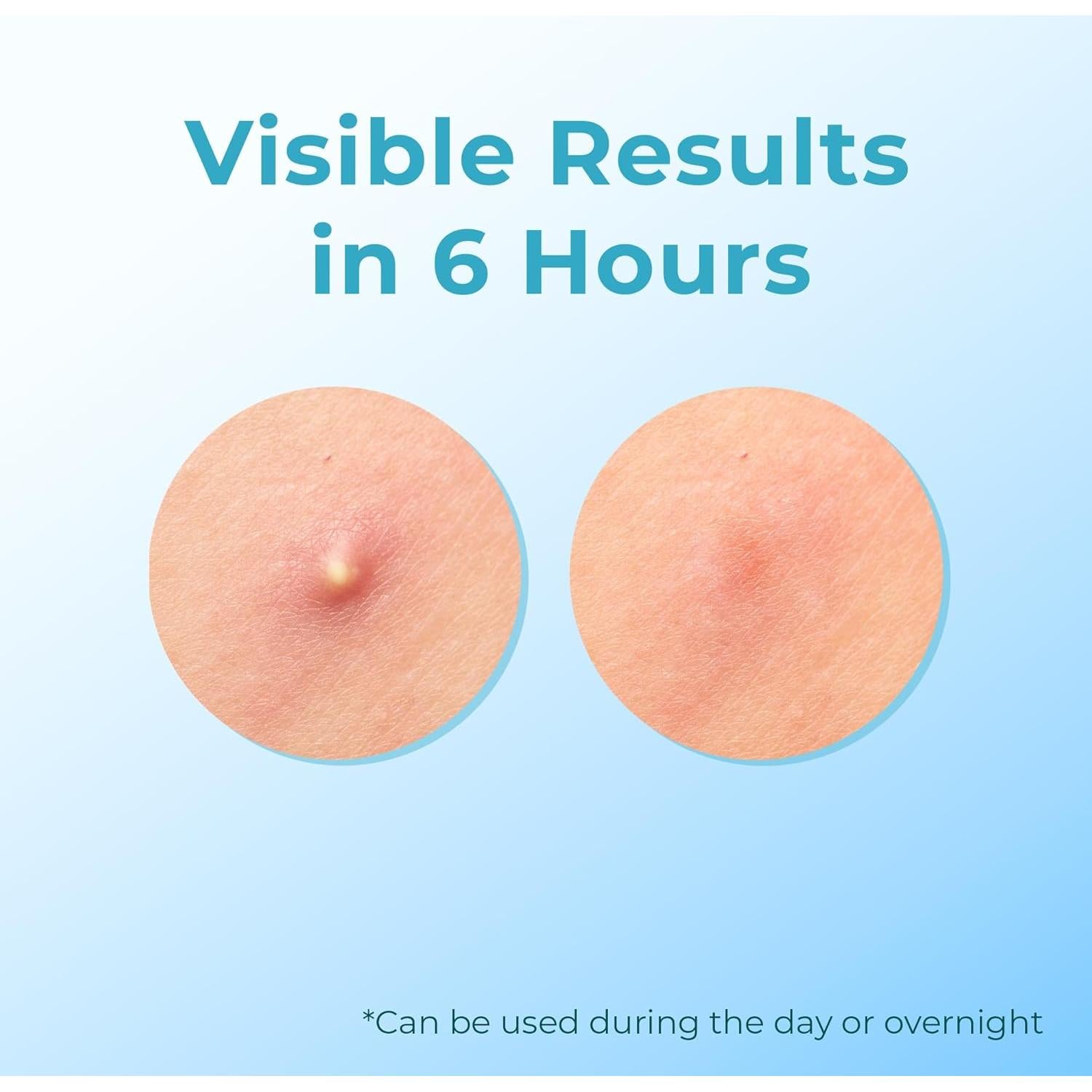 Parches para Granos CLEOF - Hidrocoloide 12mm, Vegano, Hipoalergénico