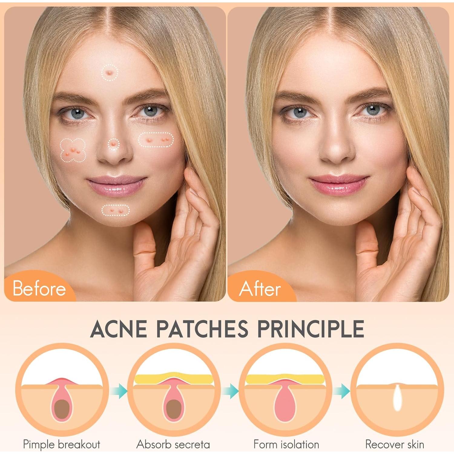 Parche Hidrocoloide para Acné AOAWI - 182 Piezas, 4 Tamaños