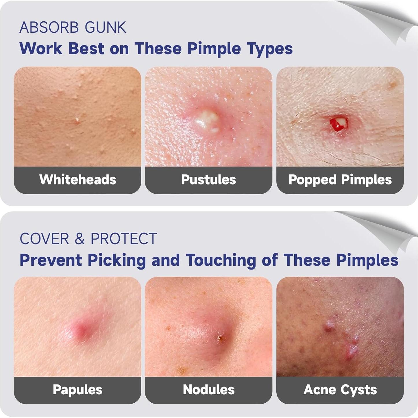 Parche Hidrocoloide para Acné Dazzlook Corazón Rosa 48 Pcs