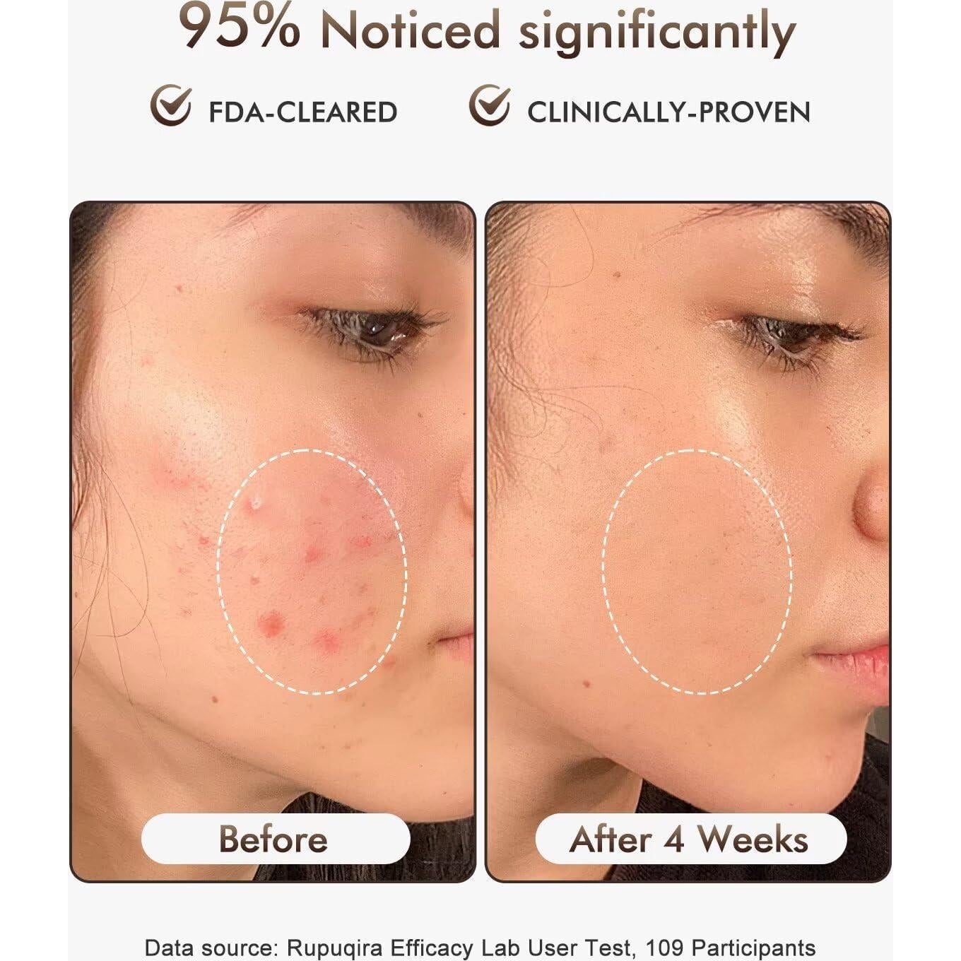 Máscara Facial de Terapia de Luz LED Rupuqira G3 - 4 Modos