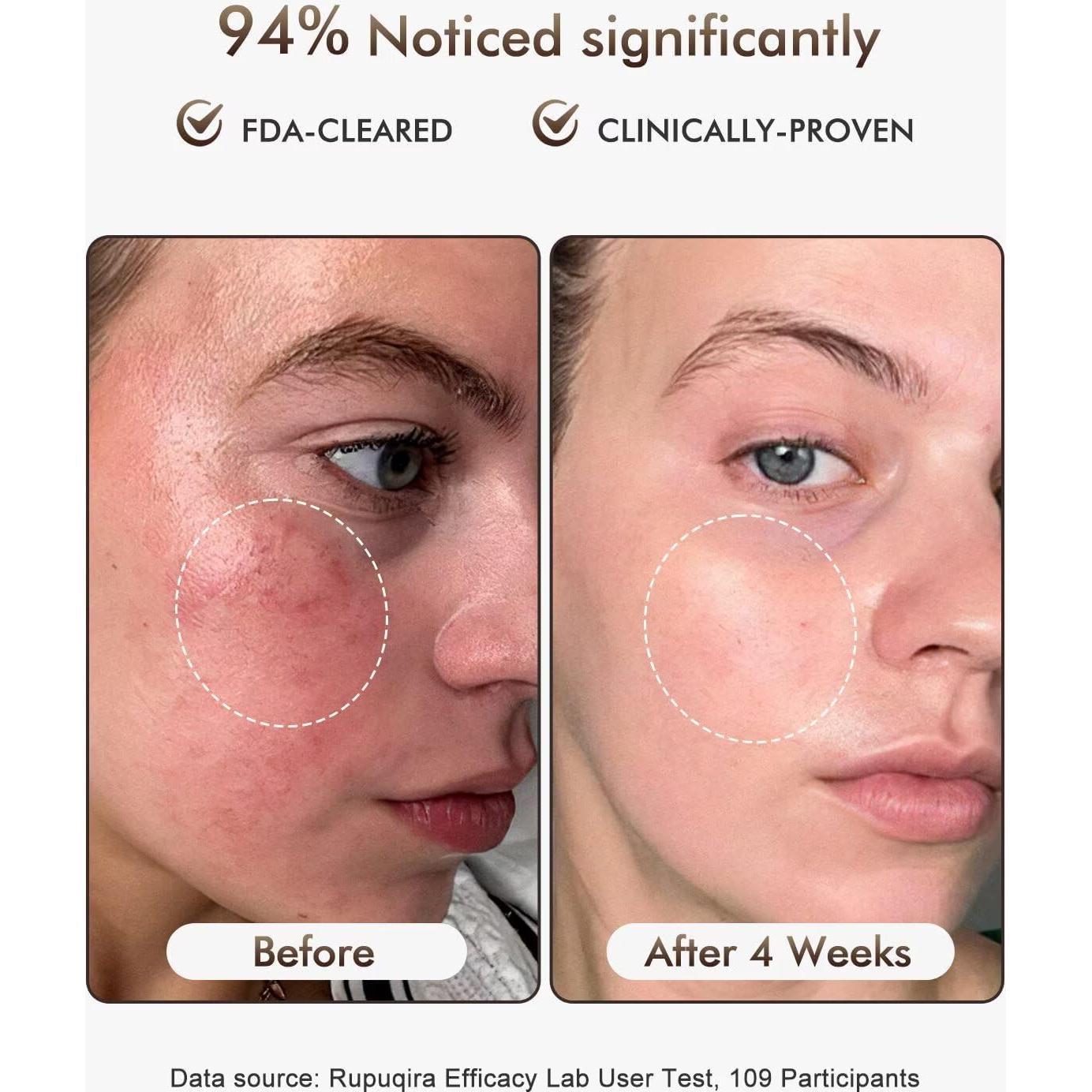 Máscara Facial de Terapia de Luz LED Rupuqira G3 - 4 Modos