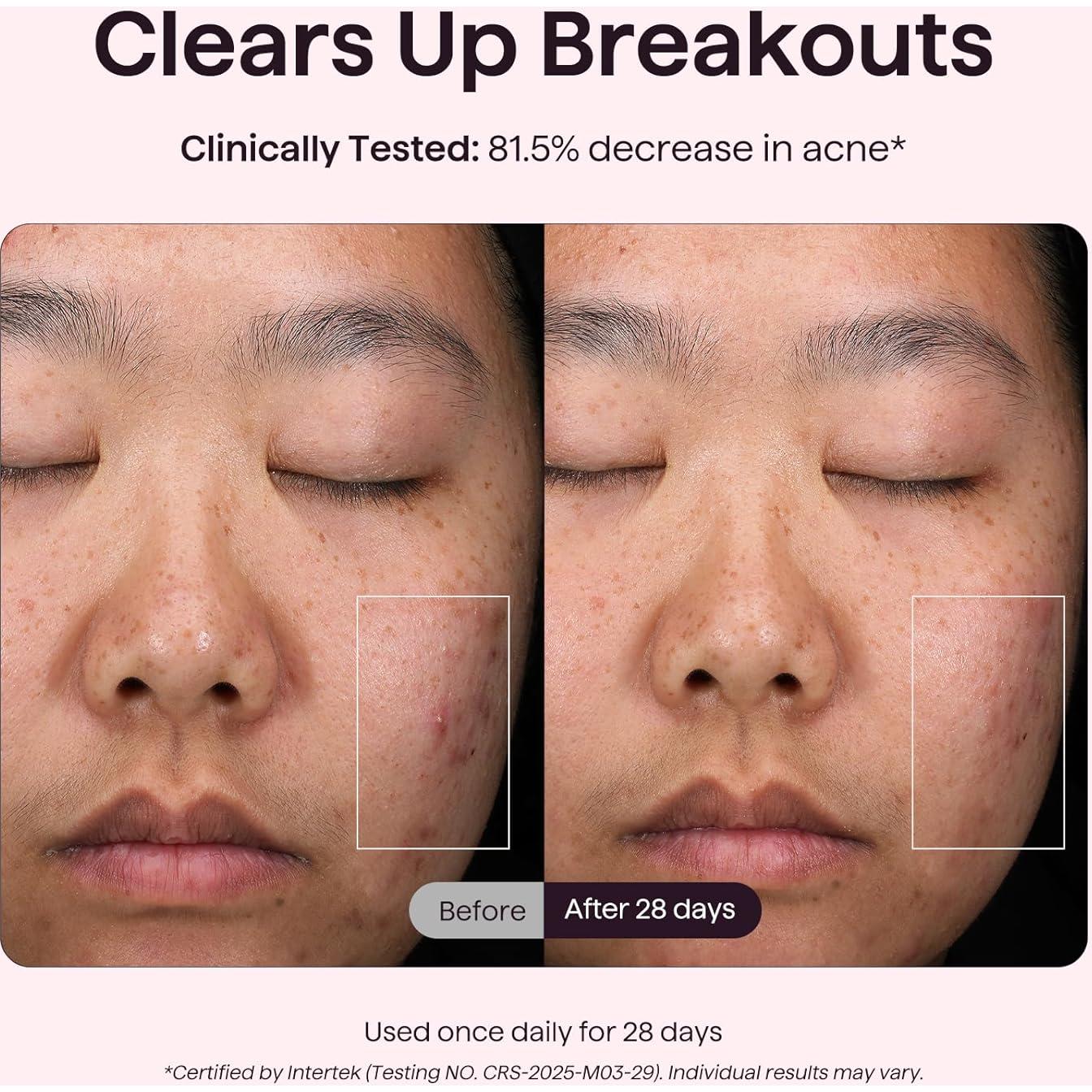 Máscara de Terapia de Luz LED Wavytalk para Rejuvenecimiento Facial