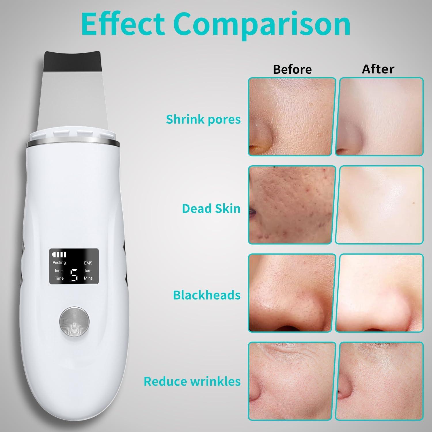 Espátula Facial QYCSL 4 en 1 - Limpieza Profunda y Exfoliación