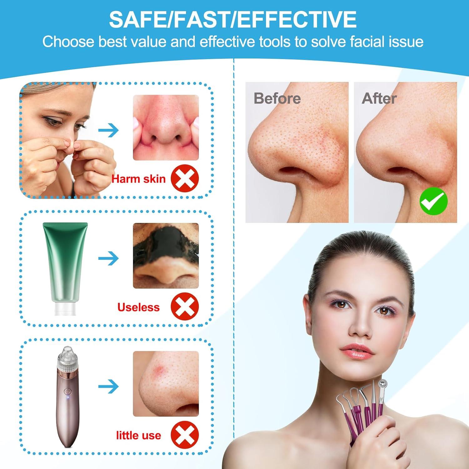 Kit de Herramientas para Puntos Negros UWOIST - 5 Piezas