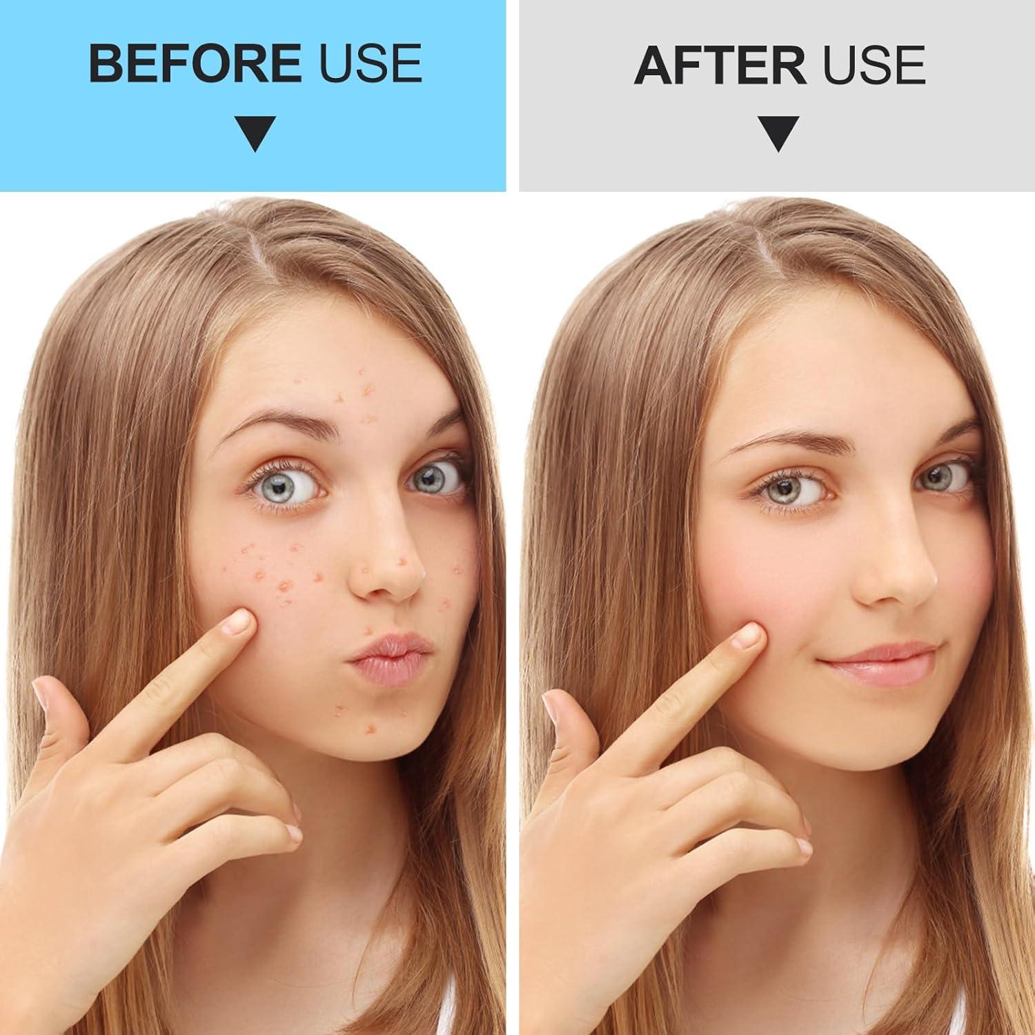 Kit de Herramientas para Puntos Negros UWOIST - 5 Piezas