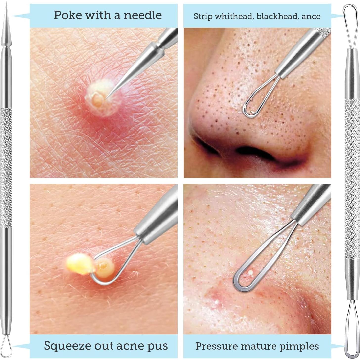 Kit de Herramientas para Remover Puntos Negros LitBear - Acero Inoxidable