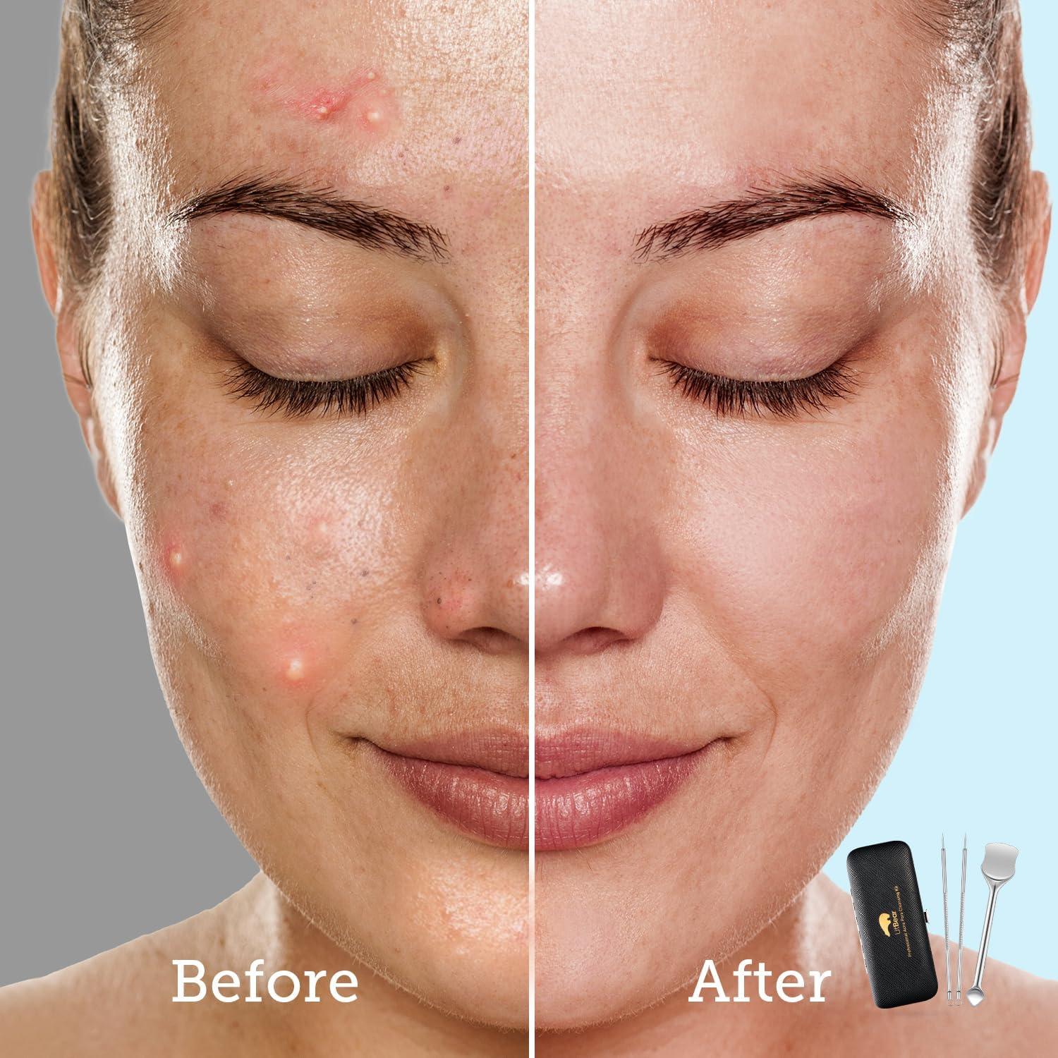 Kit de Herramientas para Remover Puntos Negros LitBear - Acero Inoxidable