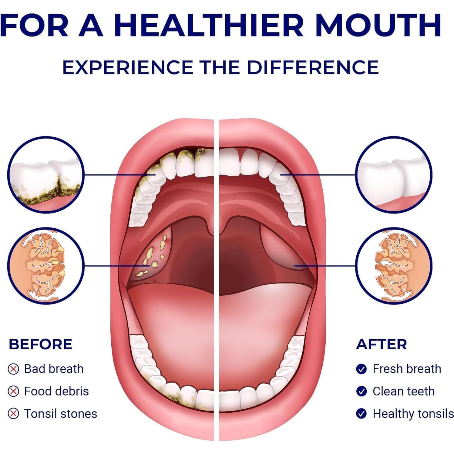 Irrigador Dental Manual ORAVIX para Dientes y Amígdalas