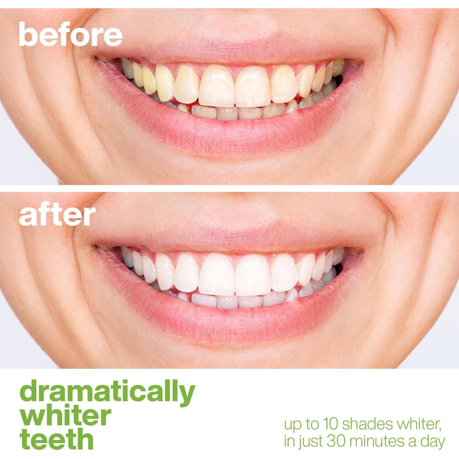 Tiras Blanqueadoras AquaSonic - Blanqueamiento Dental Efectivo