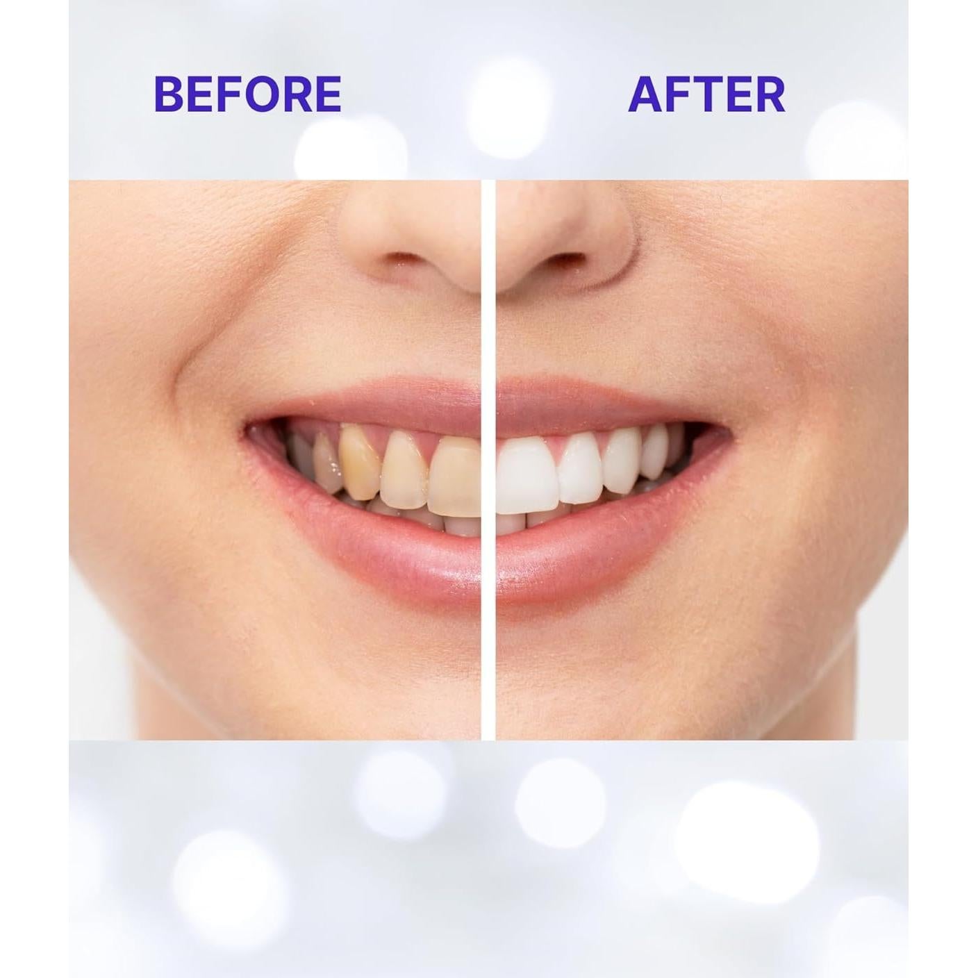 Tiras Blanqueadoras de Dientes WSD Labs - 14 Días para Dientes Sensibles