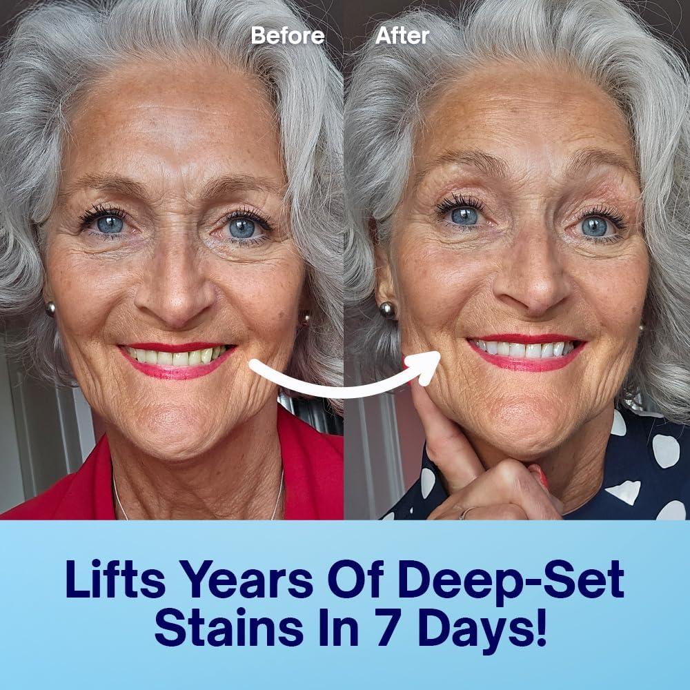 Tiras Blanqueadoras de Dientes MySweetSmile - 21 Tratamientos