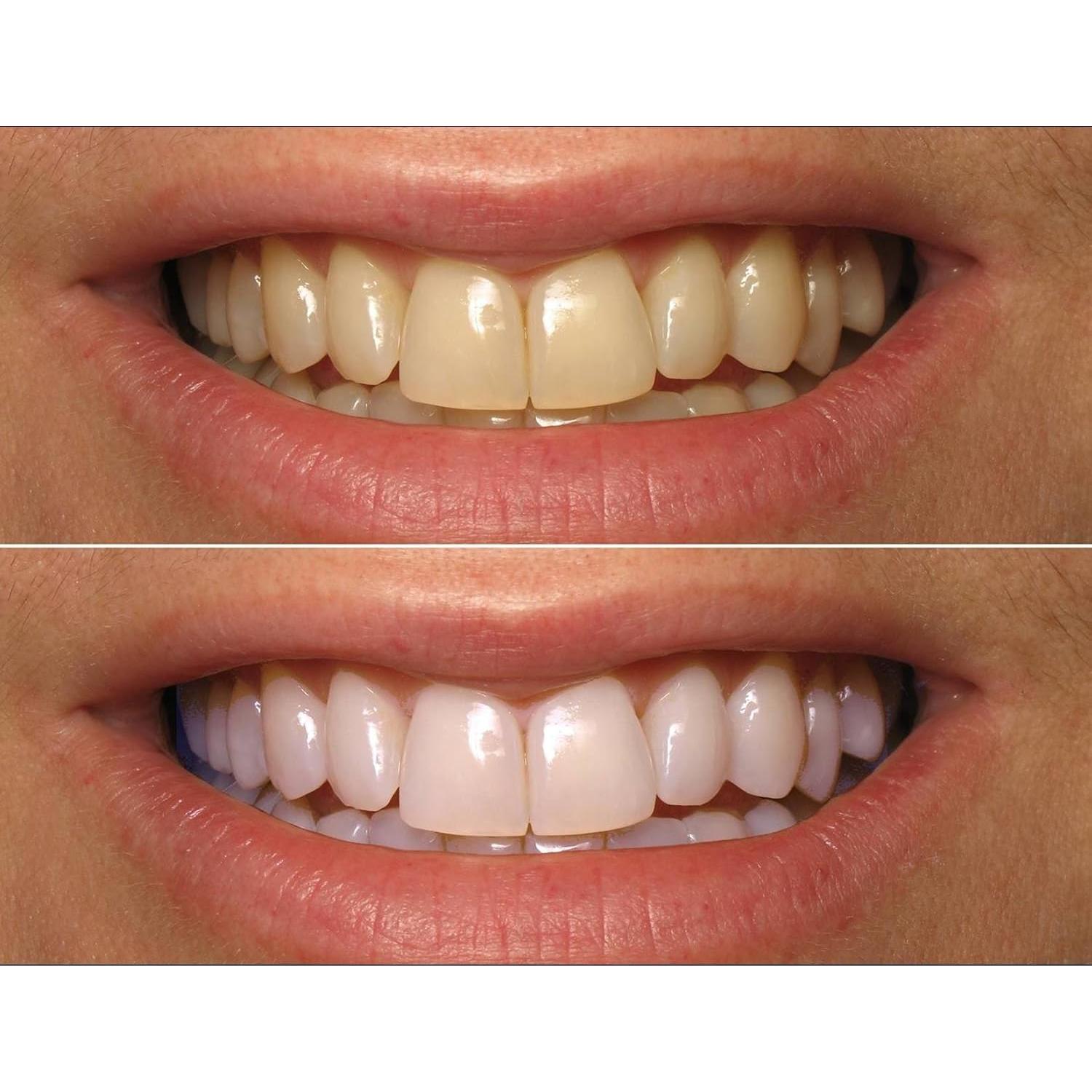 Gel Blanqueador Dental ProDental 10 Jeringas 35% Peróxido