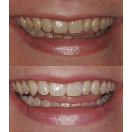 Gel Blanqueador Dental ProDental 10 Jeringas 35% Peróxido
