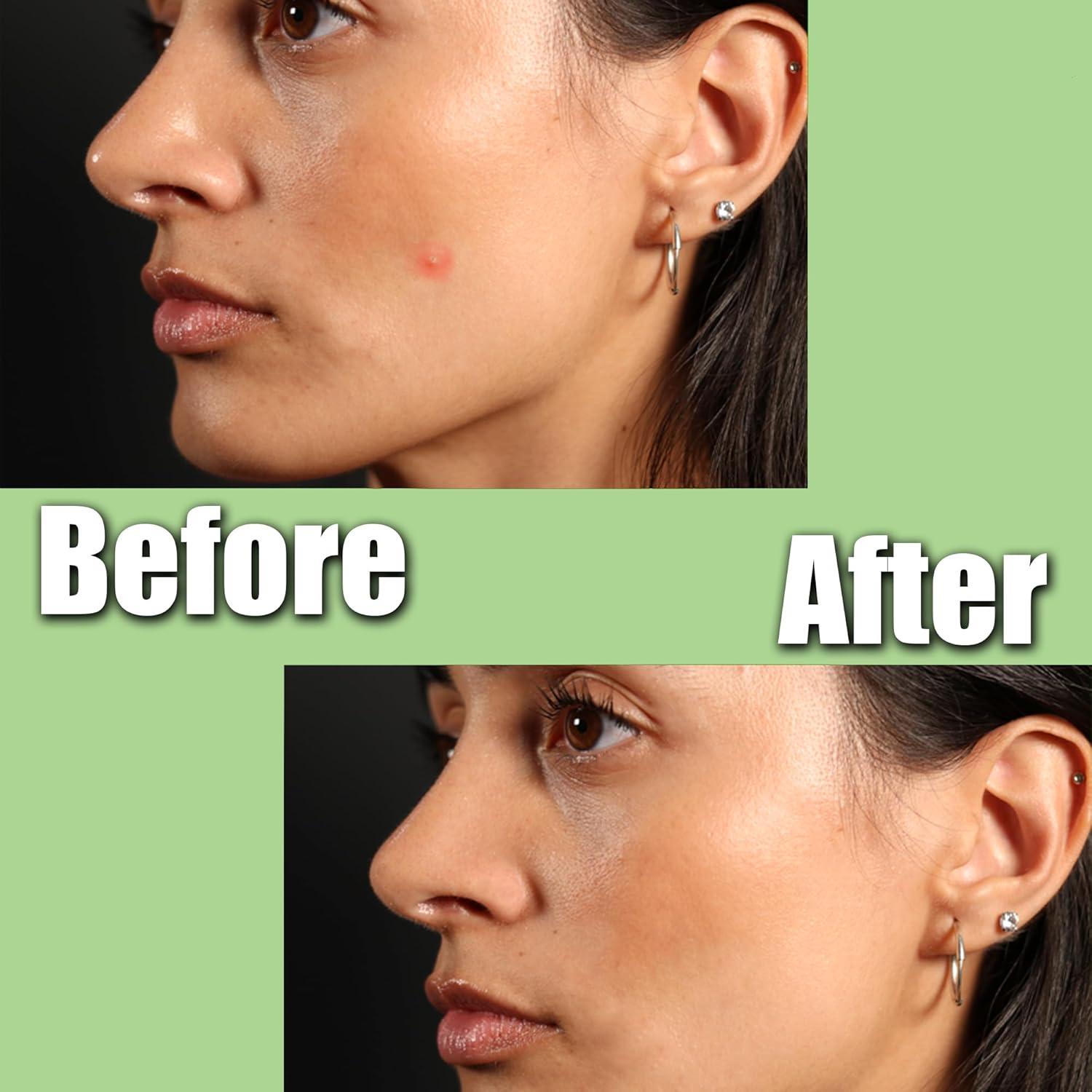 Parche para Acné FlexPharm - 72 Unidades Hidrocoloide 8mm y 10mm