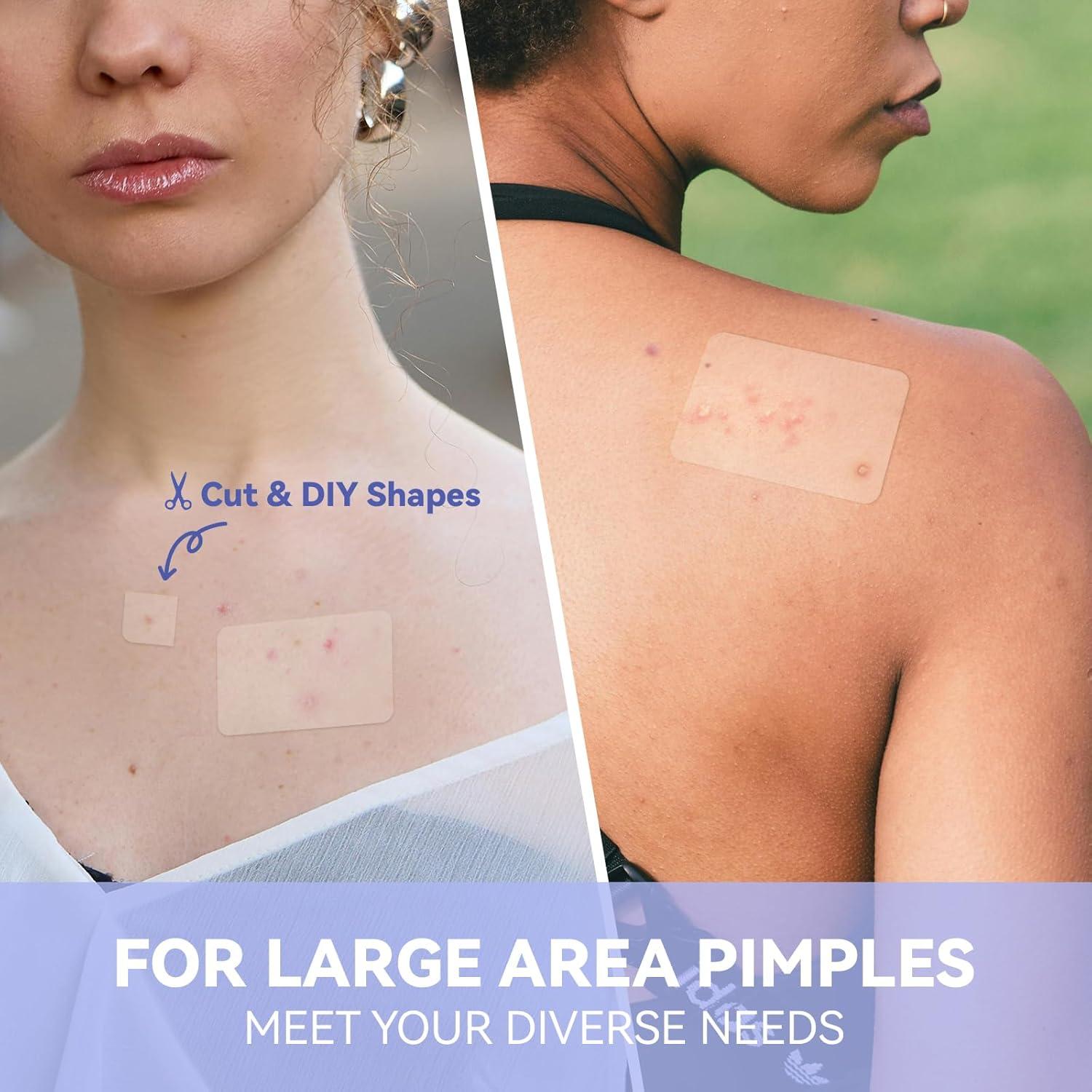 Parches para Granos Dazzlook XL - 8 Unidades con Ácido Salicílico