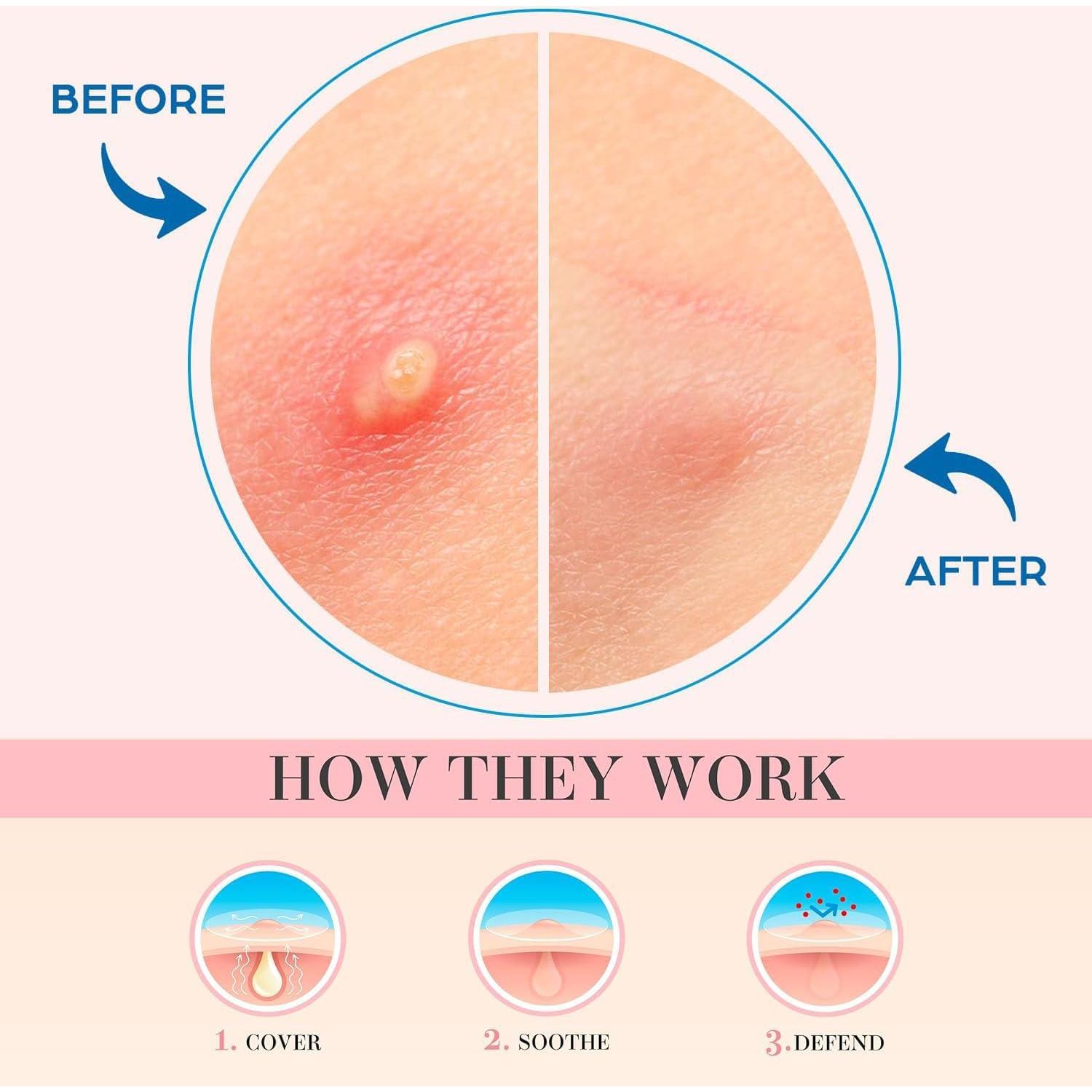 Parches Hidrocoloides OUKEYA para Granitos - 36 Unidades