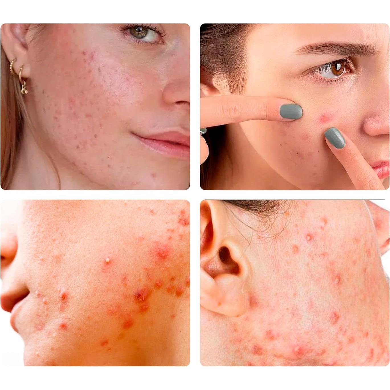 Parches Hidrocoloides OUKEYA para Granitos - 36 Unidades