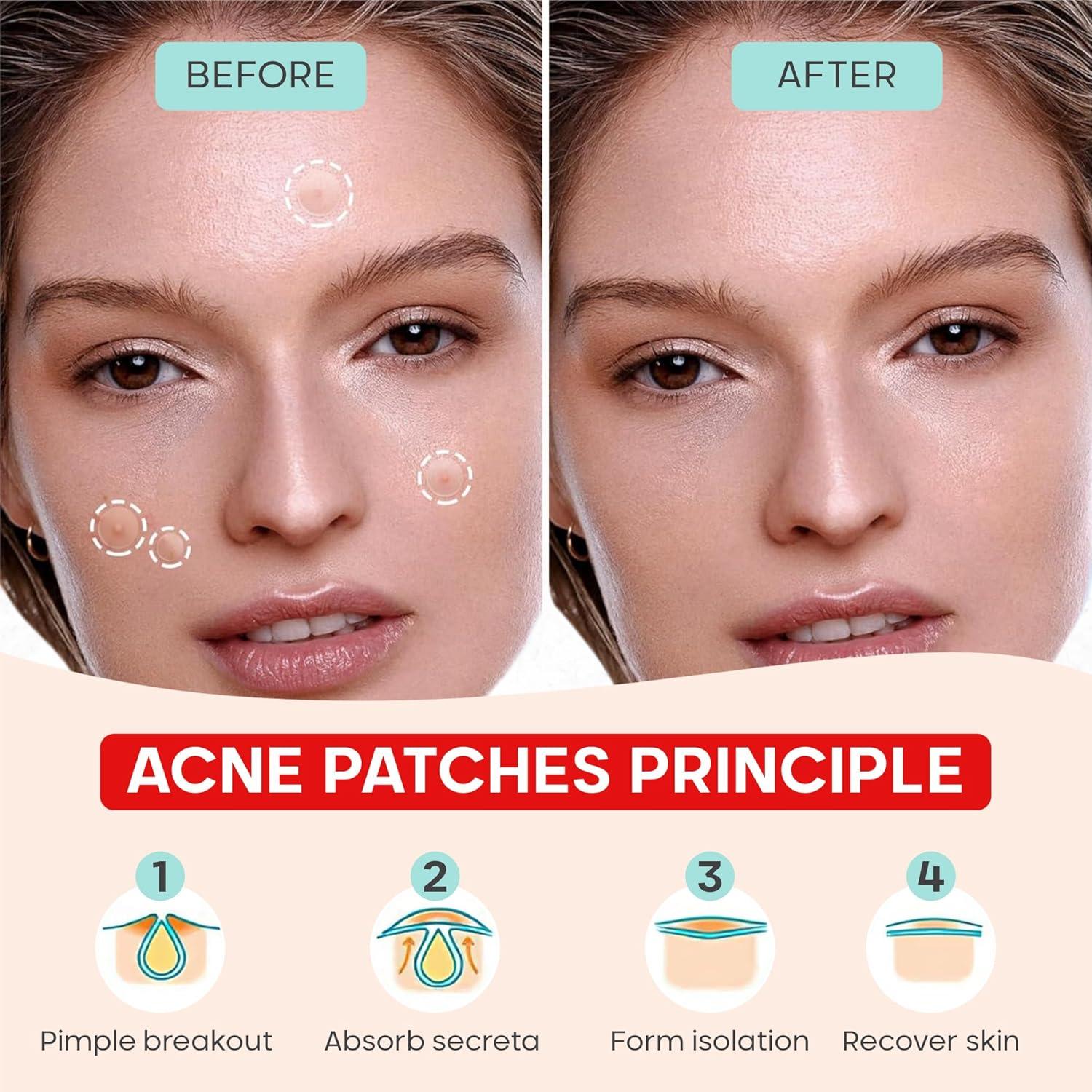 Parches Hidrocoloides SootheRX para Acné - 12x8cm - Vegano