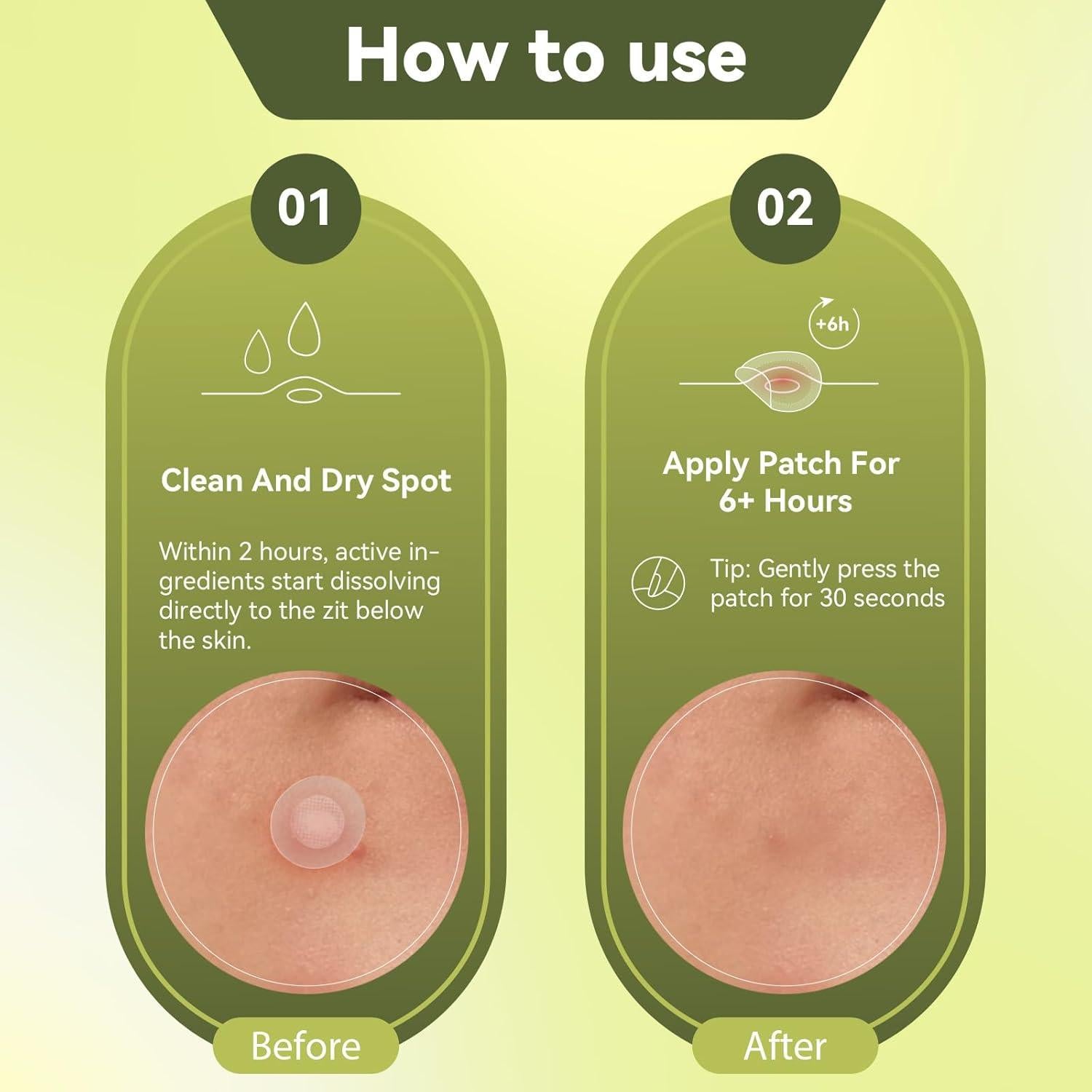 Parche para Acné Naterido Microdart 24 Piezas Ácido Hialurónico