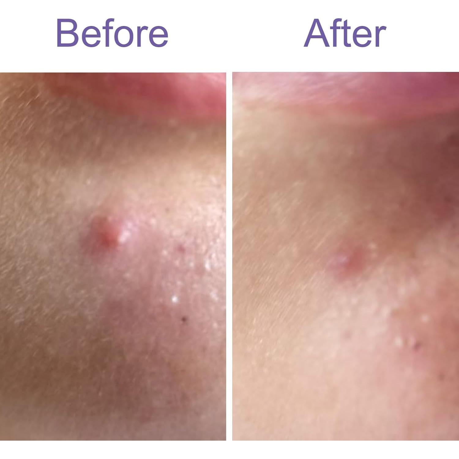 Parche Hidrocoloide para Acné Yorkline - 120 Unidades con Ácido Salicílico