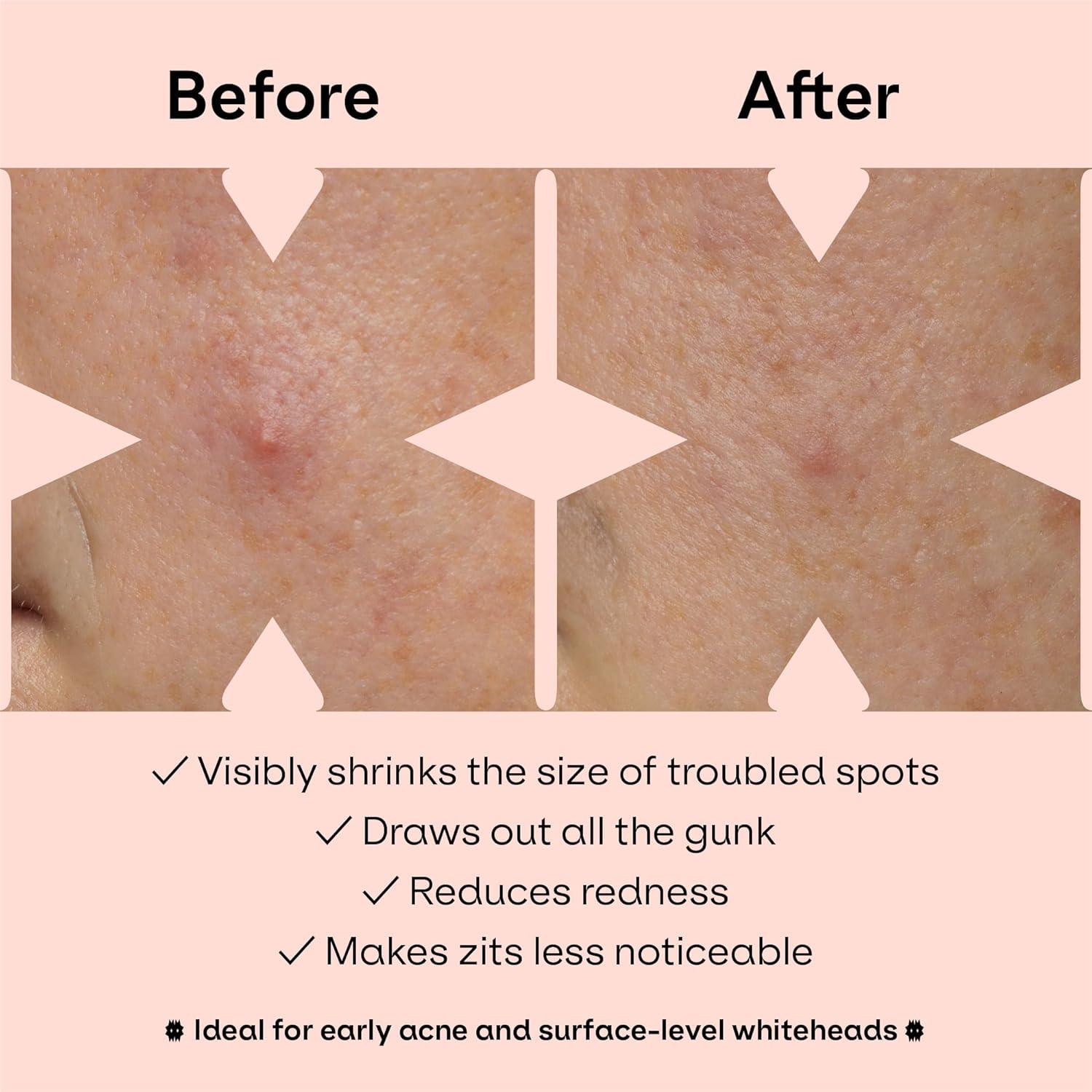 Parches para Granos Hidrocoloide ZVYK - 28 Diseños Lindo