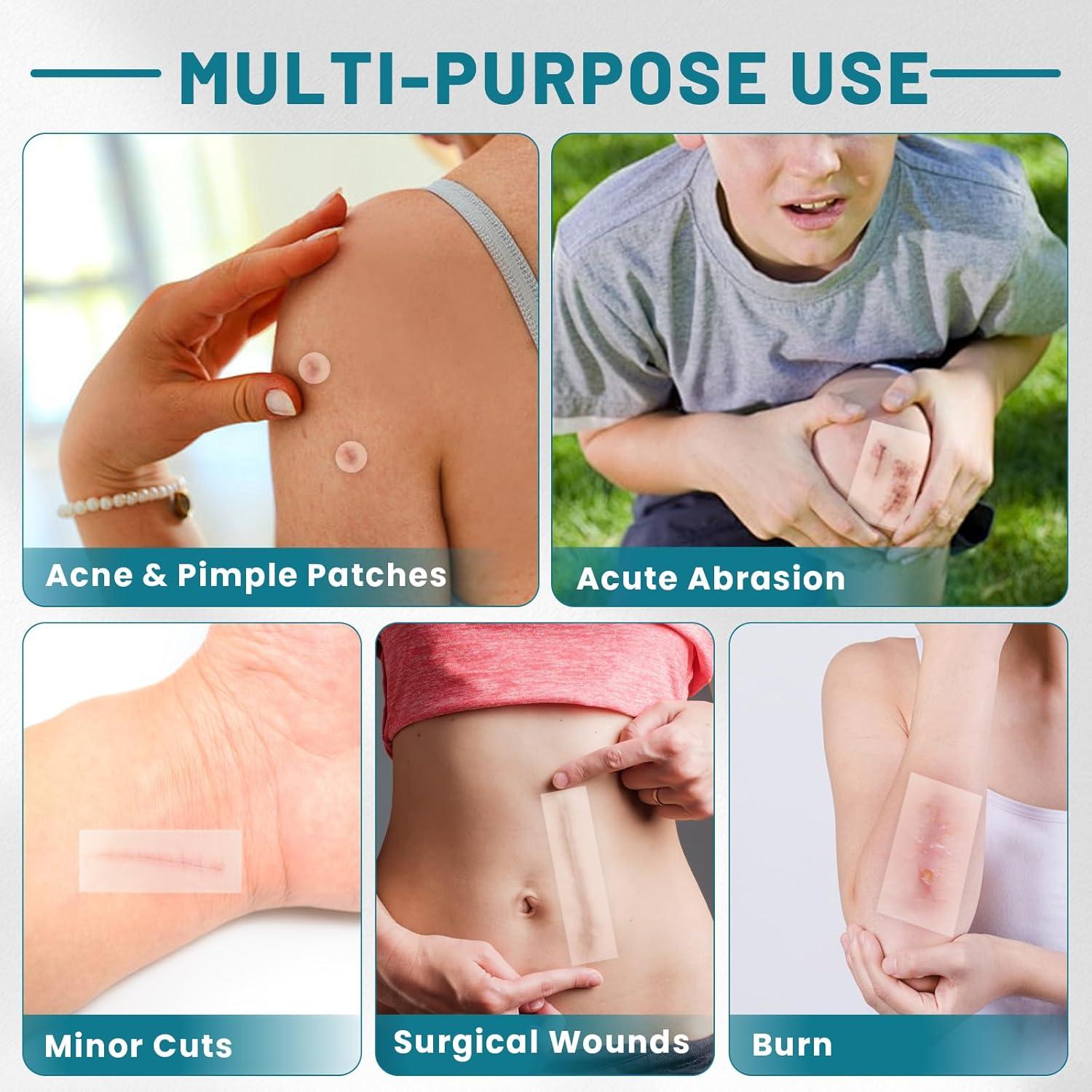 Rollo de Hidrocoloide WUYUAN 5cm x 5m Vendajes Impermeables