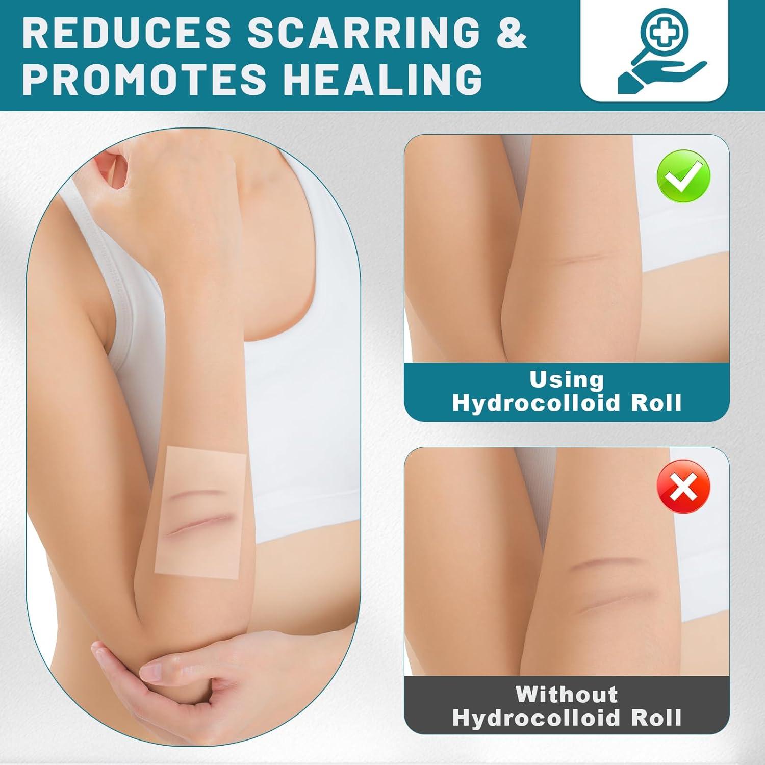 Rollo de Hidrocoloide WUYUAN 5cm x 5m Vendajes Impermeables