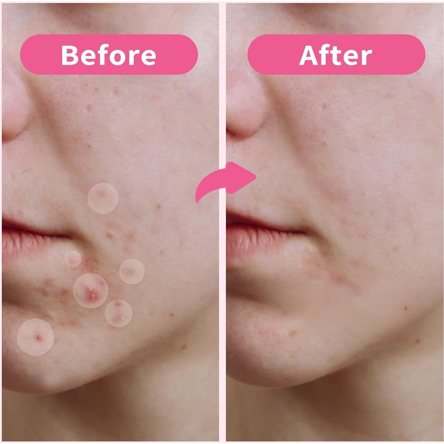 Parches para Granos Aufisi - 300 Piezas Hidrocoloides