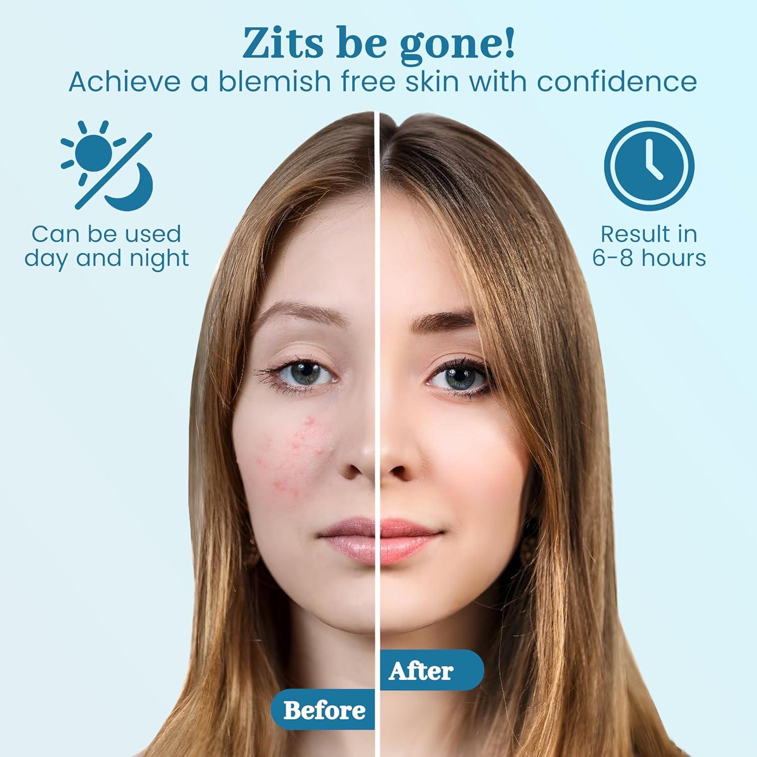 Parche Hidrocoloide para Acné Clean Slate Squad - 4 Tamaños